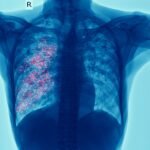El cáncer de pulmón sigue siendo la principal causa de muerte por cáncer: la detección temprana es clave para cambiar esta realidad
